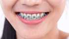 Why You Need To Be Serious About Silver Braces?